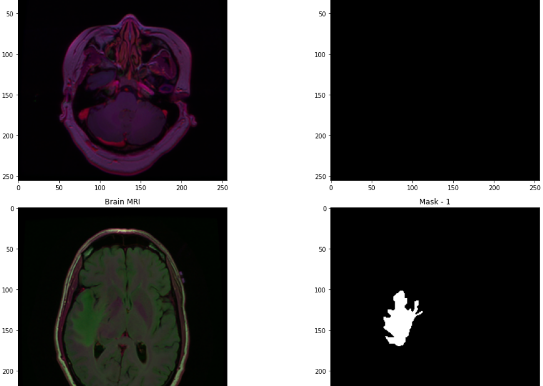 Brain Tumor Detection and segmentation using ML